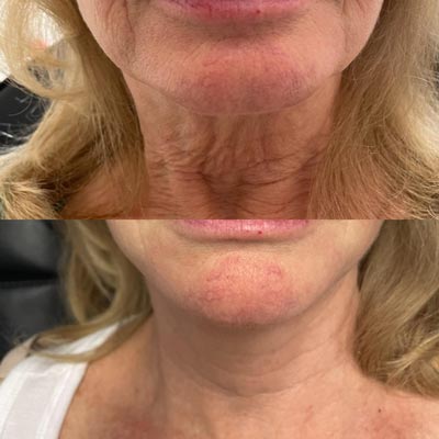 Before and After Images of Clients at True Medical Aesthetics in Avon, CT