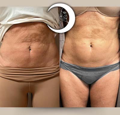 Before and After Images of Clients at True Medical Aesthetics in Avon, CT