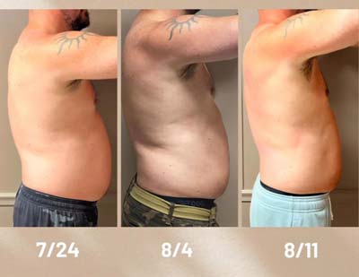 Before and After Images of Clients at True Medical Aesthetics in Avon, CT