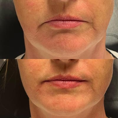Before and After Images of Clients at True Medical Aesthetics in Avon, CT