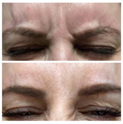 Before and After Images of Clients at True Medical Aesthetics in Avon, CT