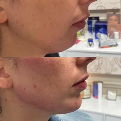 Before and After Images of Clients at True Medical Aesthetics in Avon, CT