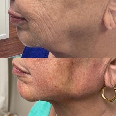 Before and After Images of Clients at True Medical Aesthetics in Avon, CT
