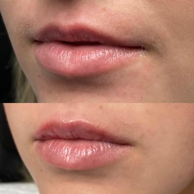 Before and After Images of Clients at True Medical Aesthetics in Avon, CT