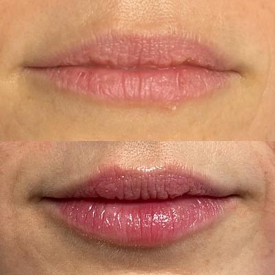 Before and After Images of Clients at True Medical Aesthetics in Avon, CT