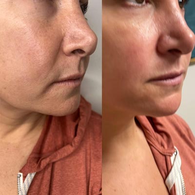 Before and After Images of Clients at True Medical Aesthetics in Avon, CT