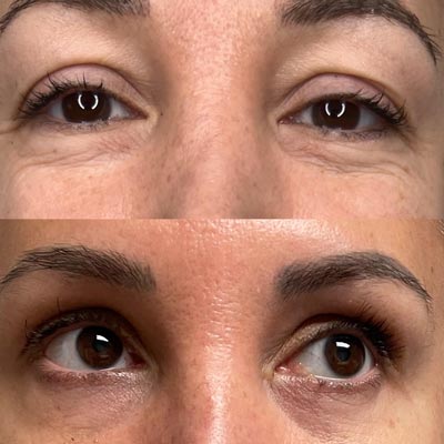 Before and After Images of Clients at True Medical Aesthetics in Avon, CT