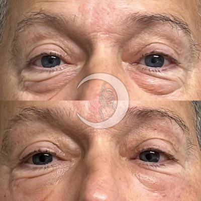 Before and After Images of Clients at True Medical Aesthetics in Avon, CT
