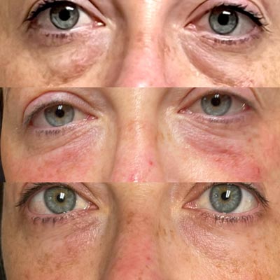 Before and After Images of Clients at True Medical Aesthetics in Avon, CT