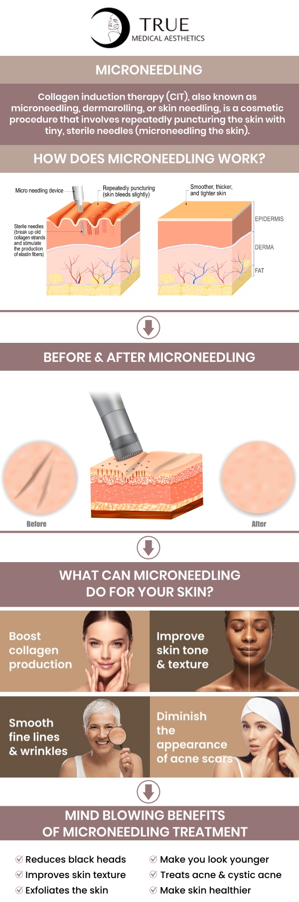 Radiofrequency Microneedling stimulates the body through a natural process to produce stronger, healthier, more youthful skin. It can reduce signs of aging, including fine lines and skin laxity, as well as improve skin tone, texture, and acne scars. Consult Tristen Durkin, RN, and her team at True Medical Aesthetics to restore and rejuvenate your skin with Radiofrequency Microneedling. We are conveniently located at 50 Avon Meadow Lane Avon, CT 06001. For more information, contact us or request an appointment online.