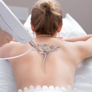 Tattoo Removal at True Medical Aesthetics in Avon, CT